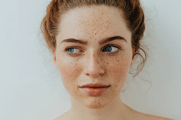 9 mẹo đối phó với tàn nhang trên mặt