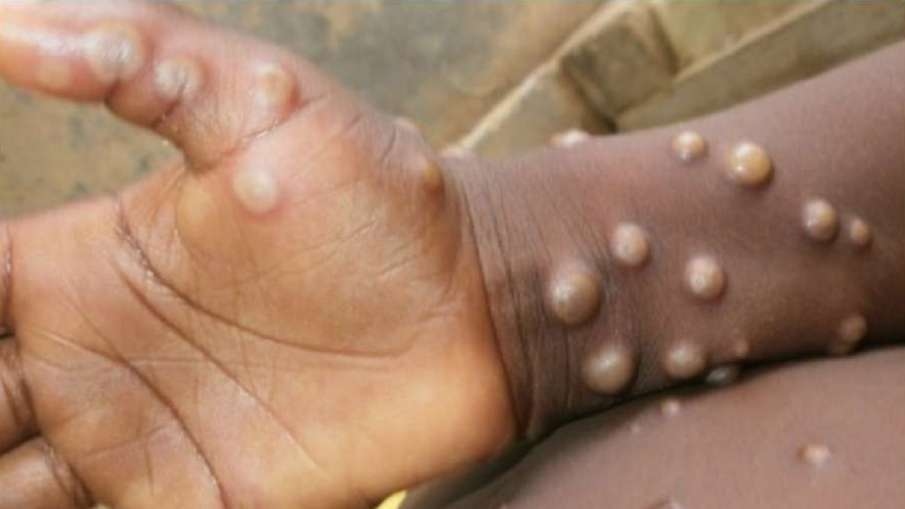 Ấn Độ ghi nhận trường hợp đầu tiên tử vong vì bệnh đậu mùa khỉ