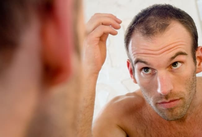 Rụng tóc ở nam giới và các phương pháp điều trị