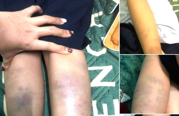 Không khởi tố hình sự vụ học sinh lớp 1 ở Đà Nẵng bị bầm tím chân tay