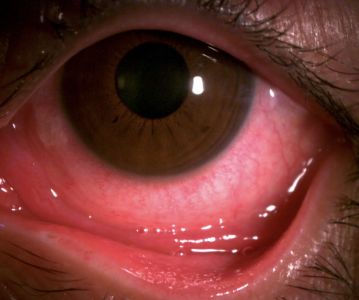 Đau mắt đỏ có thể biến chứng nguy hiểm, mất thị lực vĩnh viễn