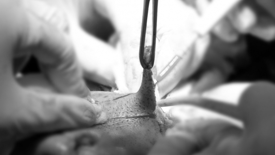 9 giờ căng não cắt khối mặt xệ cho người đàn ông mang “khuôn mặt quỷ”