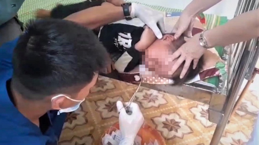 Gắp con đỉa trong mũi bé trai 4 tuổi ở Yên Bái