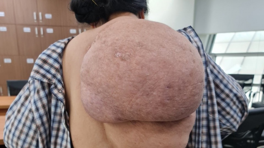 Người phụ nữ 53 tuổi gánh trên vai khối u khổng lồ