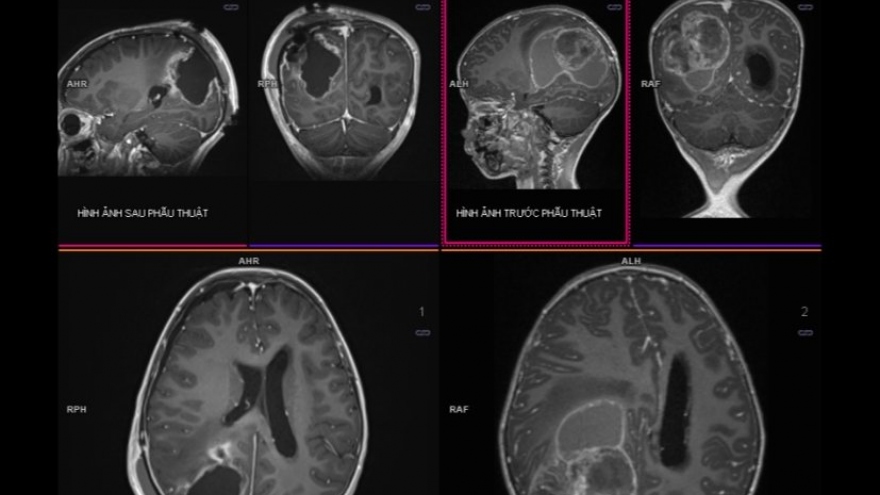 9 dấu hiệu cảnh báo u não ở trẻ em, cha mẹ chớ bỏ qua