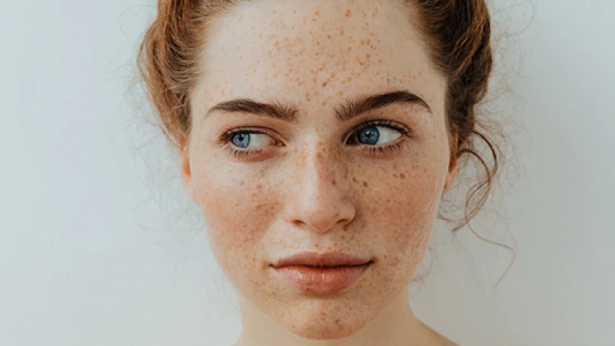 9 mẹo đối phó với tàn nhang trên mặt