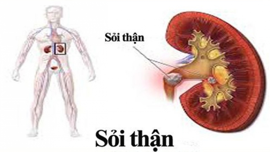 Vì sao nhiều người Việt Nam bị mắc sỏi thận?