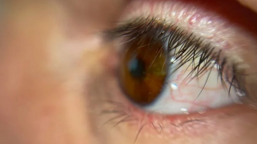 Bệnh nhân đầu tiên trên thế giới được lắp mắt giả bằng công nghệ in 3D