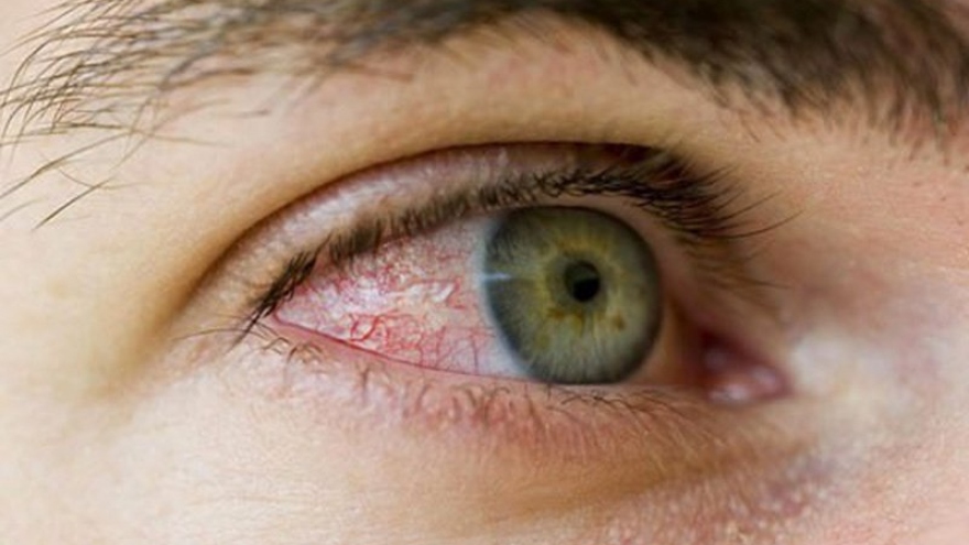 Triệu chứng hiếm gặp của COVID-19 xuất hiện ở mắt