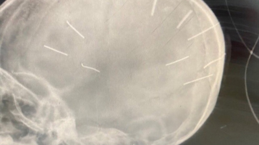Bé 3 tuổi ở Hà Nội hôn mê, chụp X-quang thấy vật thể giống đinh trong hộp sọ