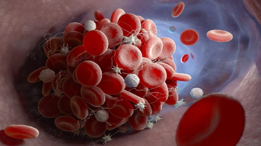 Các nhà khoa học phát hiện kháng thể gây đông máu do COVID-19