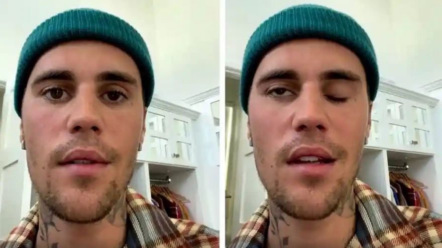 Justin Bieber bị tê liệt nửa mặt vì mắc căn bệnh lạ