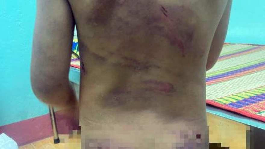 Bé 7 tuổi nghi bị bạo hành ở Bình Phước đã được đưa đi điều trị 