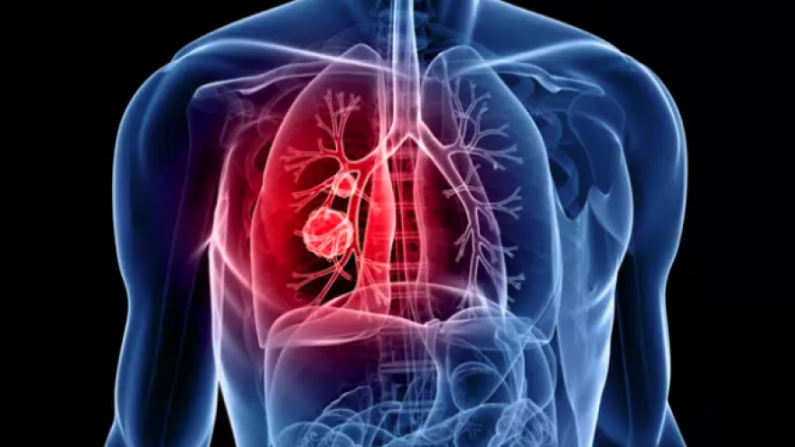 Các triệu chứng ban đầu của bệnh ung thư phổi cần đề phòng