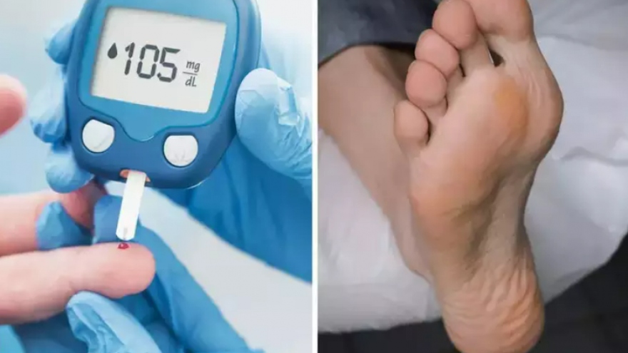 7 dấu hiệu ở chân cho thấy lượng đường trong máu cao