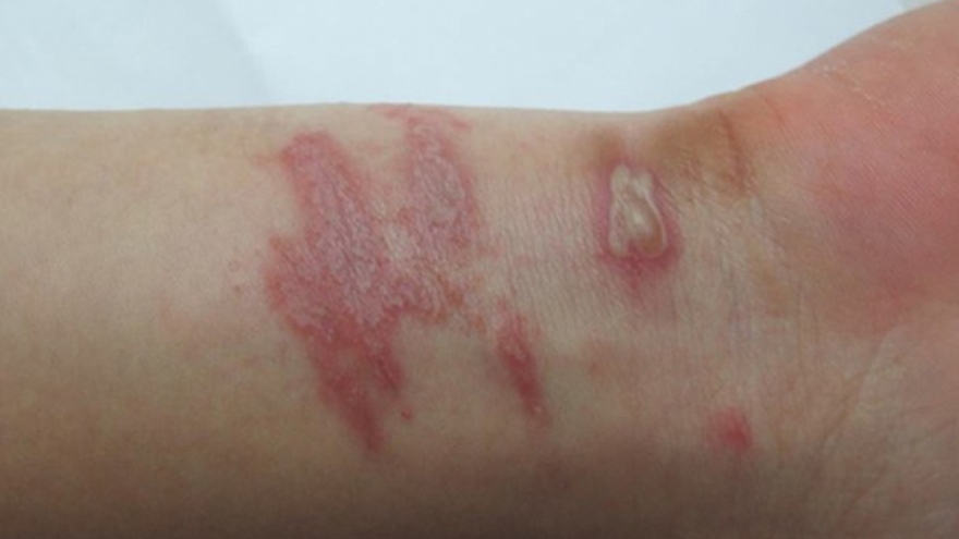 Nhiều người bị viêm da do tiếp xúc với kiến ba khoang