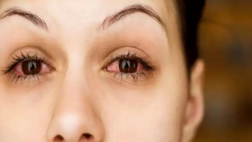 Nguyên nhân phổ biến khiến đôi mắt bạn đỏ ngầu