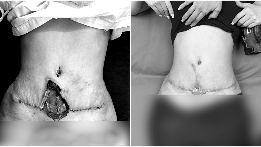 Nữ bệnh nhân bị hoại tử với vết thủng 10cm giữa bụng vì hút mỡ bụng
