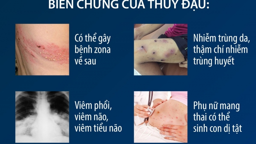 Bệnh thủy đậu bùng phát ở Hà Nội: Chuyên gia khuyến cáo cách phòng bệnh