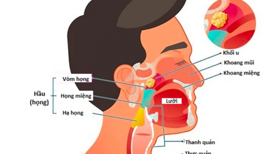 Căn bệnh ung thư đàn ông 30-50 tuổi ở Việt Nam thường gặp