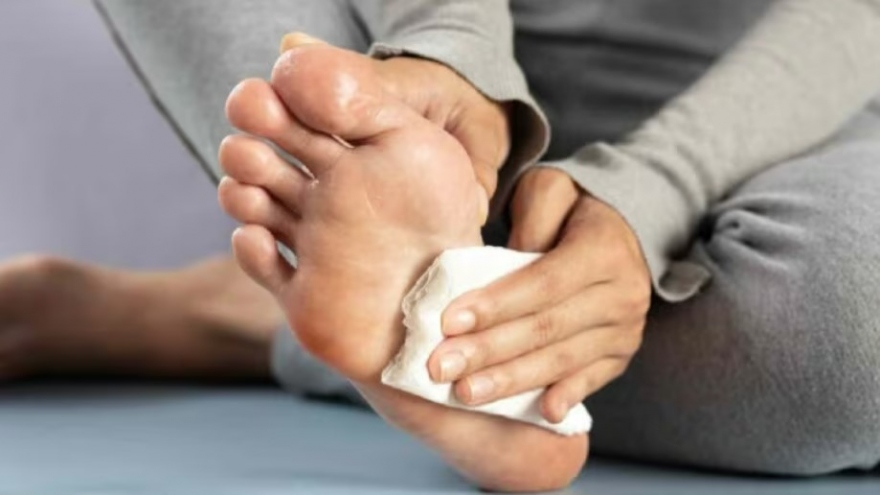 7 biện pháp điều trị chứng ra mồ hôi tay, chân