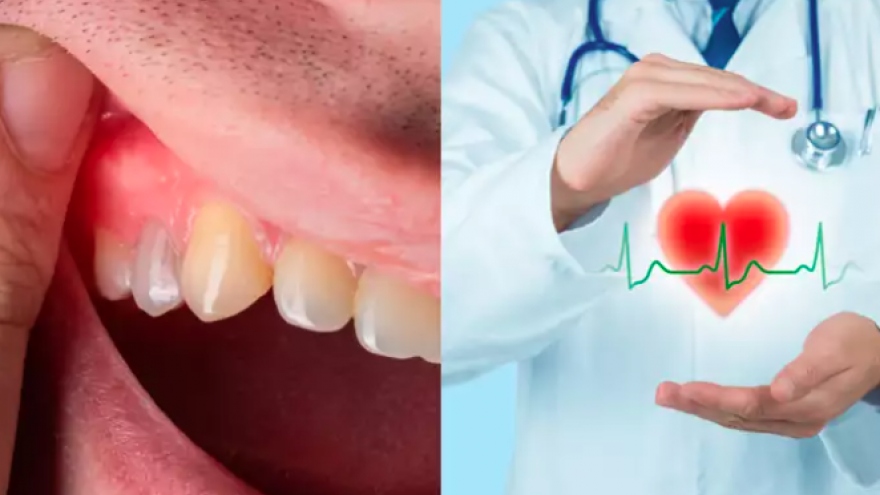 Bệnh nướu răng không được điều trị làm tăng nguy cơ mắc bệnh tim
