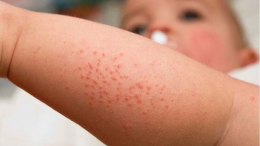42 trường hợp mắc bệnh sởi và sốt phát ban nghi sởi tại 13 tỉnh, thành phố