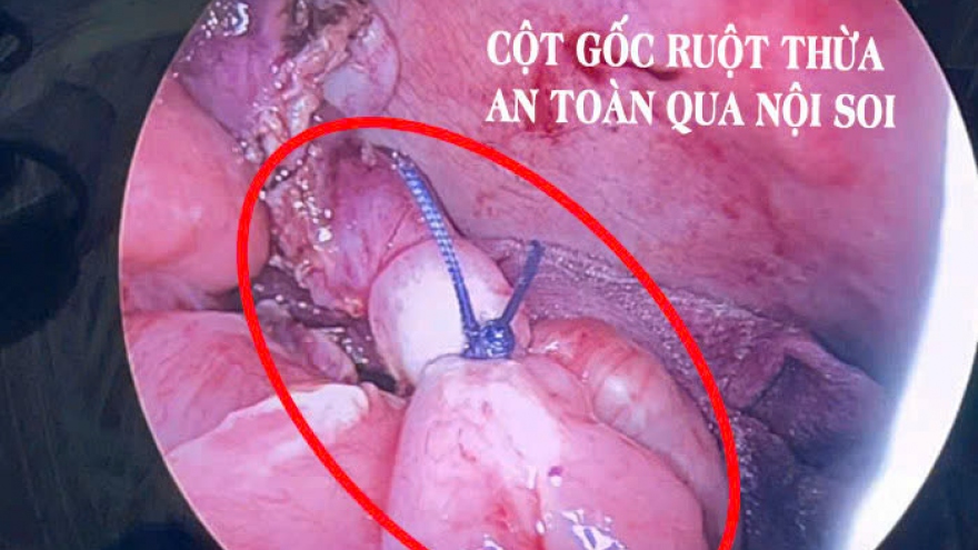 Bạc Liêu thực hiện thành công ca phẫu thuật cắt ruột thừa vỡ cho bé trai 4 tuổi