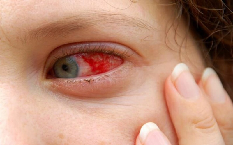 Biến chứng về mắt: Sốt xuất huyết có thể dẫn đến mù đột ngột do xuất huyết võng mạc hoặc xuất huyết trong dịch kính mắt làm mắt bị mờ.