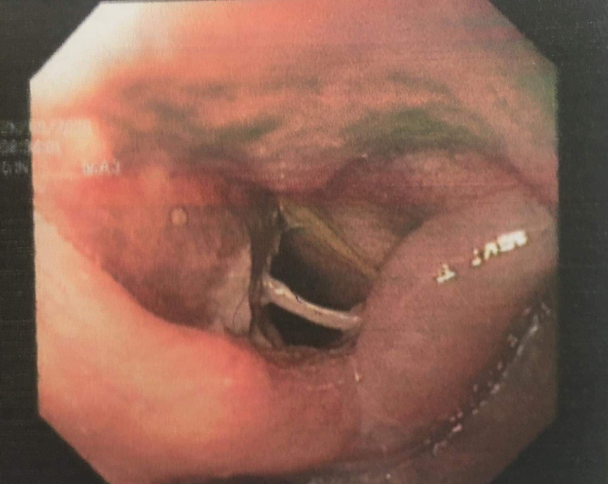 Phát hiện và gắp thành công dị vật là một đoạn xương cá dài 3cm nằm ngay dưới nắp thanh quản.