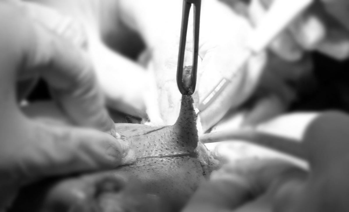 9 giờ căng não cắt khối mặt xệ cho người đàn ông mang “khuôn mặt quỷ”
