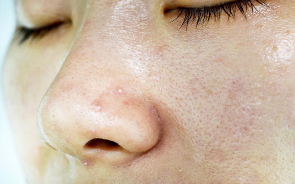 Thiếu vitamin B2 làm mắt bị kích ứng, da nhiều dầu hơn, xuất hiện mẩn đỏ và viêm chân lông.