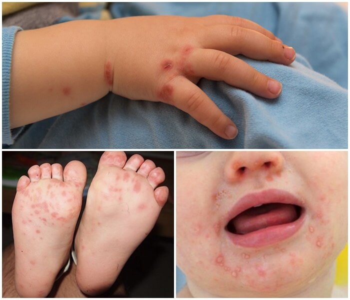 Không nên hoang mang việc thiếu thuốc điều trị bệnh tay chân miệng ở trẻ em