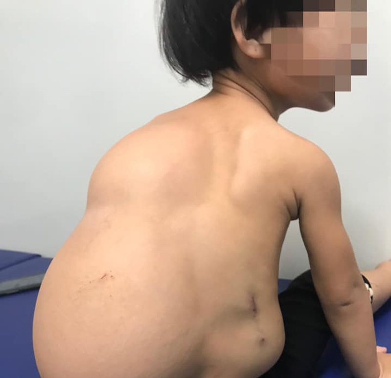 Bé gái 2 tuổi gánh trên lưng khối u mỡ khổng lồ nặng 4 kg