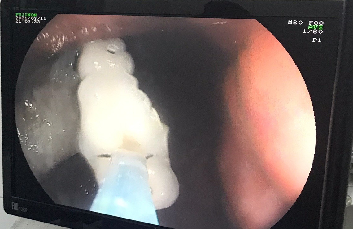 Can thiệp lấy 4 răng giả "lạc" trong dạ dày của bệnh nhân 61 tuổi