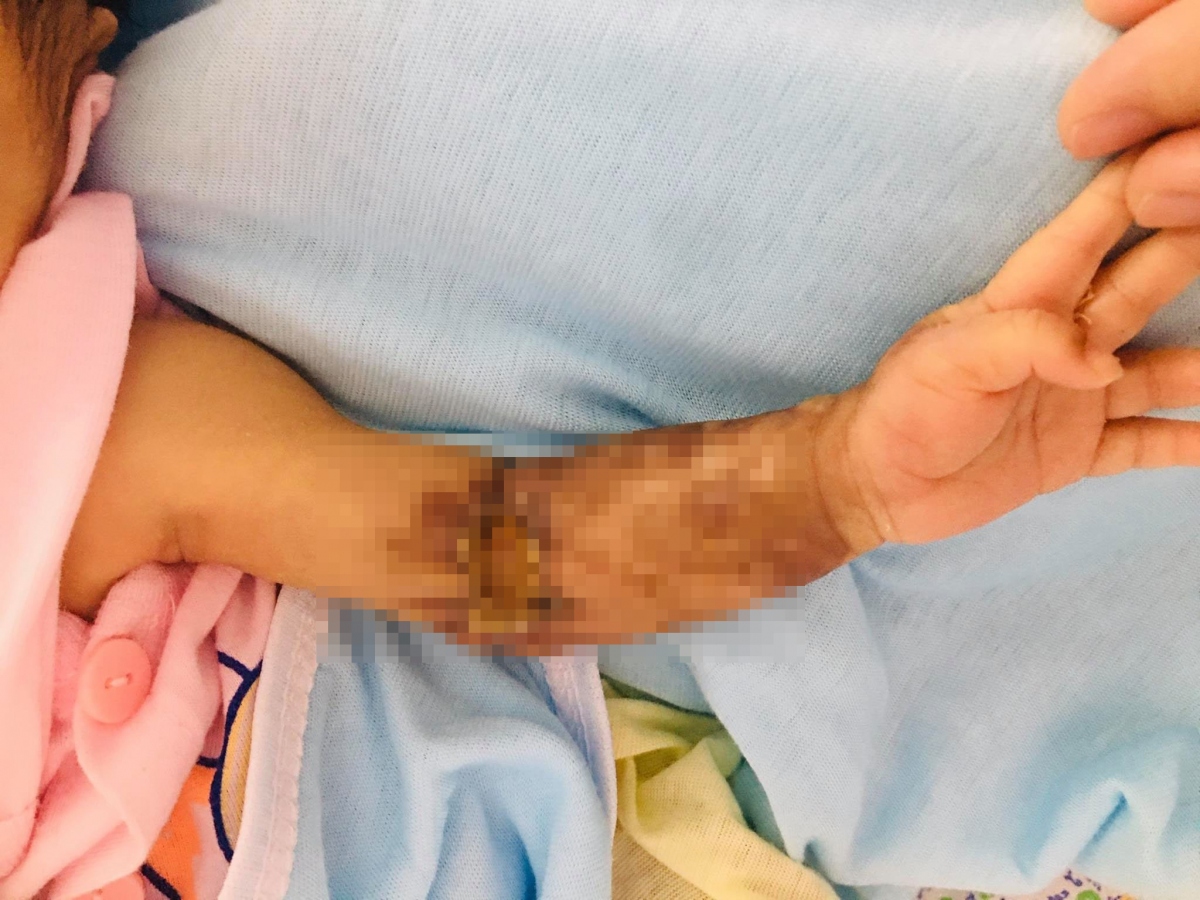 Phẫu thuật cứu cánh tay bị hoại tử của bệnh nhi 1 tháng tuổi