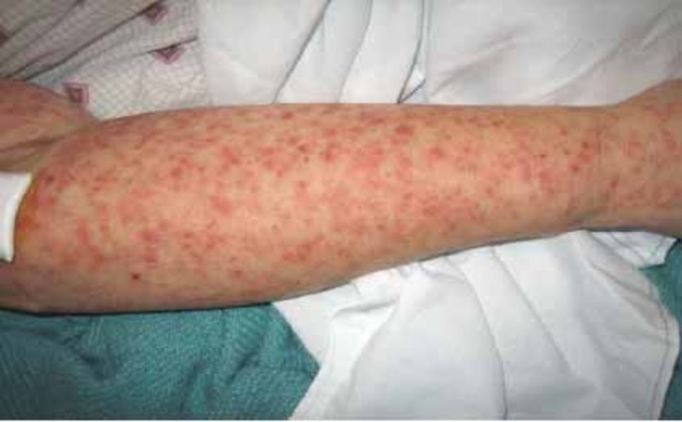 Dịch sốt virus Chikungunya bùng phát tại 13 tỉnh ở Campuchia