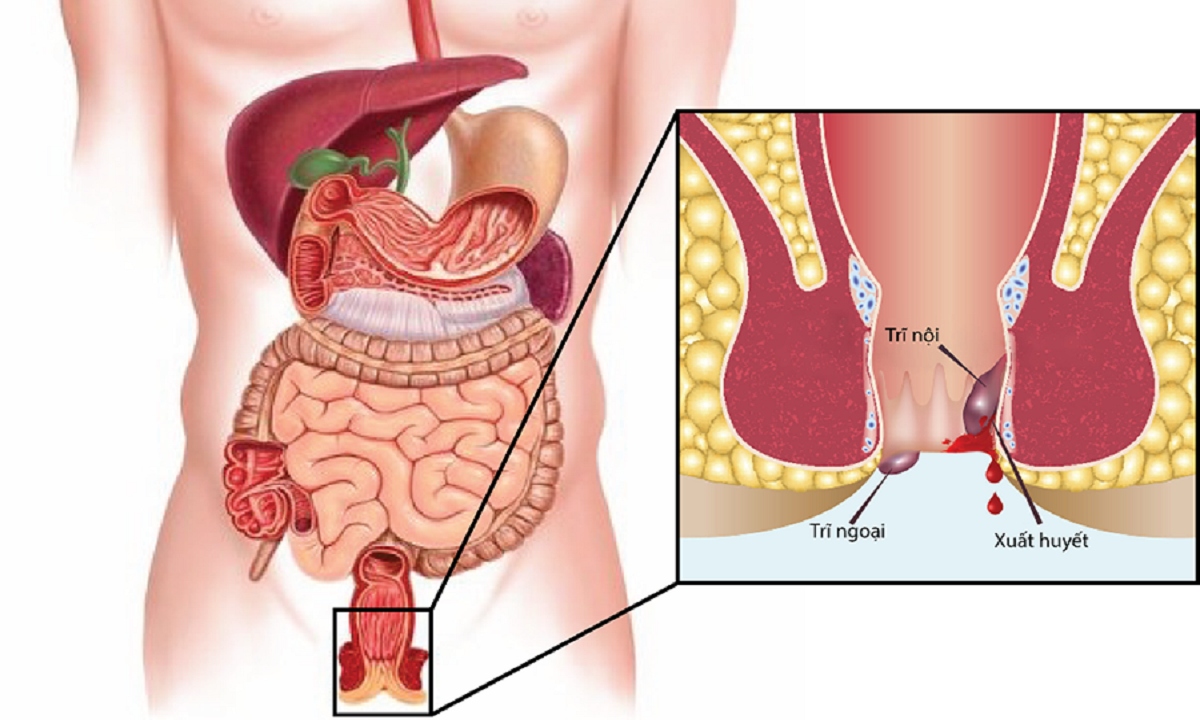 Các biện pháp khắc phục bệnh trĩ tại nhà