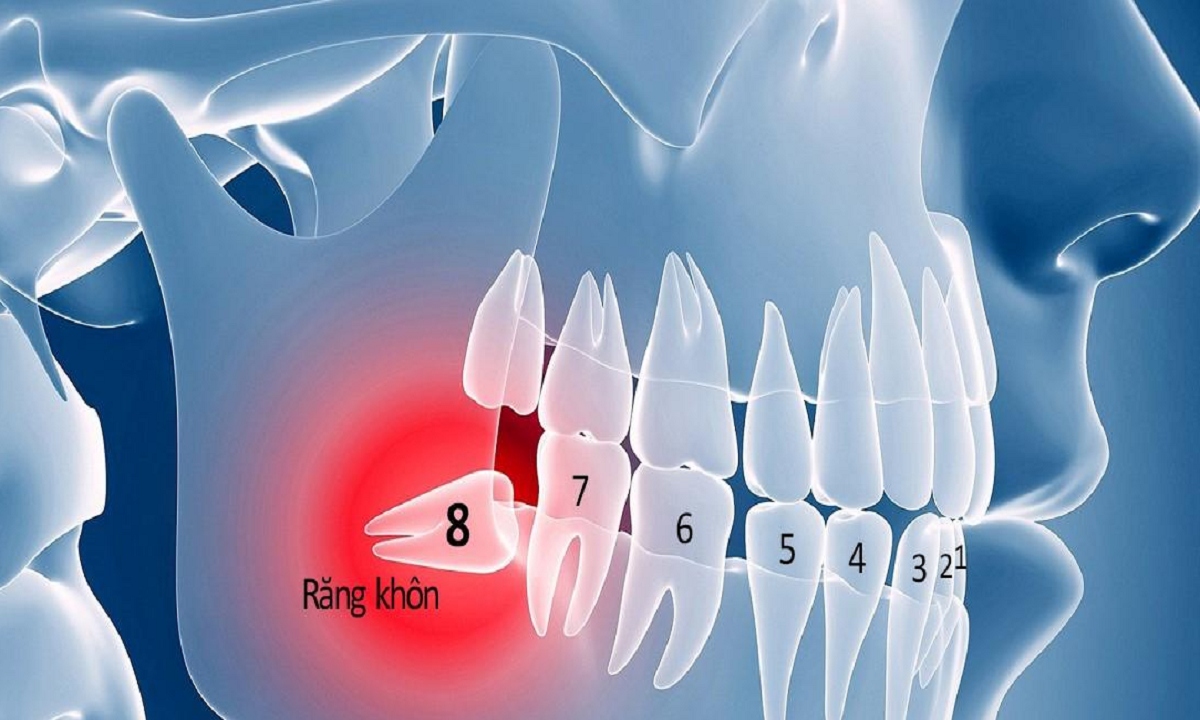 Nhổ răng khôn có thể cải thiện vị giác của bạn?