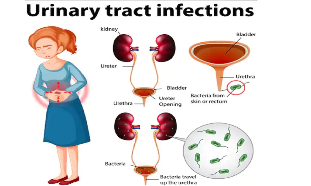 Các biện pháp giúp giảm các triệu chứng của nhiễm trùng đường tiết niệu