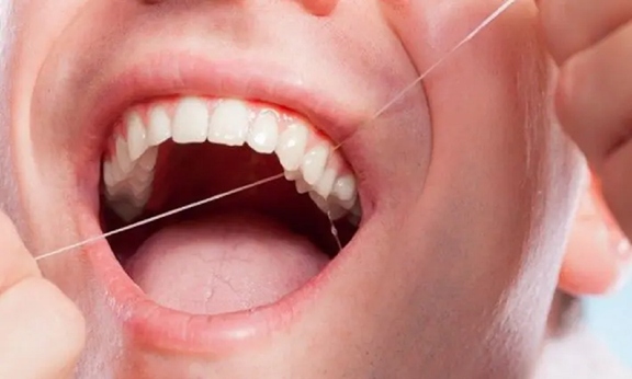 Lợi ích của việc sử dụng chỉ nha khoa trong thói quen vệ sinh răng miệng