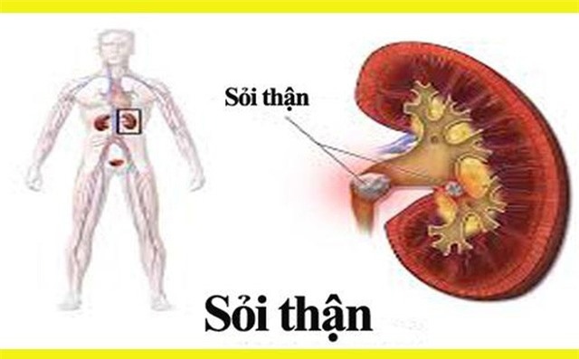 Vì sao nhiều người Việt Nam bị mắc sỏi thận?