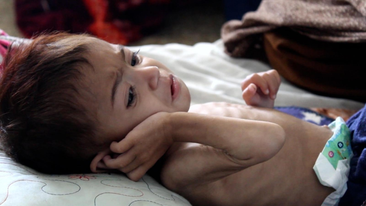 Bé gái 3 tuổi chỉ nặng bằng trẻ sơ sinh: Ám ảnh khủng hoảng đói nghèo ở Afghanistan