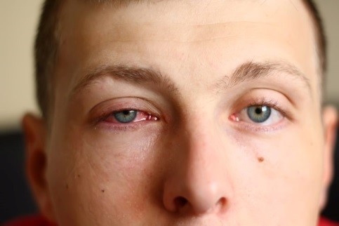 Đau mắt đỏ có phải là triệu chứng của COVID-19?