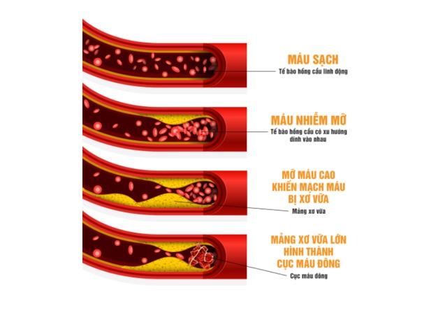 Bí quyết hạ mỡ máu cao cực hiệu quả từ Nhật Bản