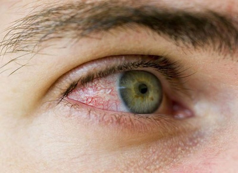 Triệu chứng hiếm gặp của COVID-19 xuất hiện ở mắt