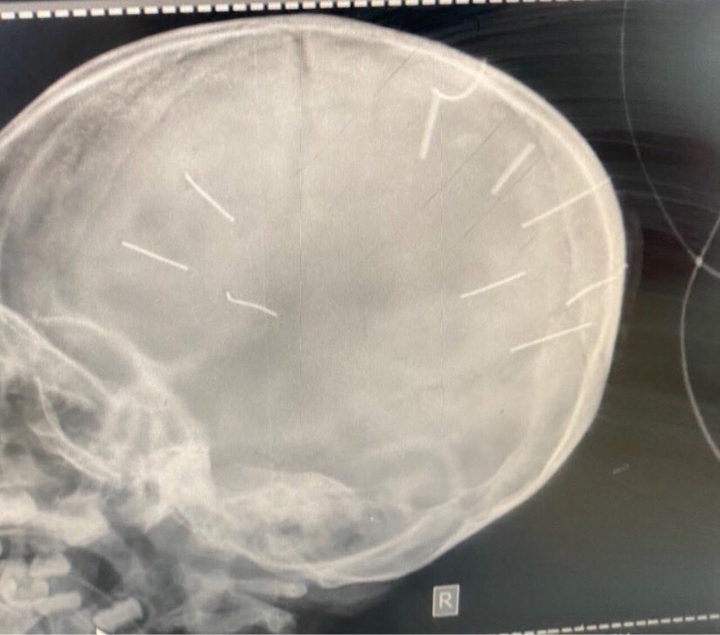 Bé 3 tuổi ở Hà Nội hôn mê, chụp X-quang thấy vật thể giống đinh trong hộp sọ