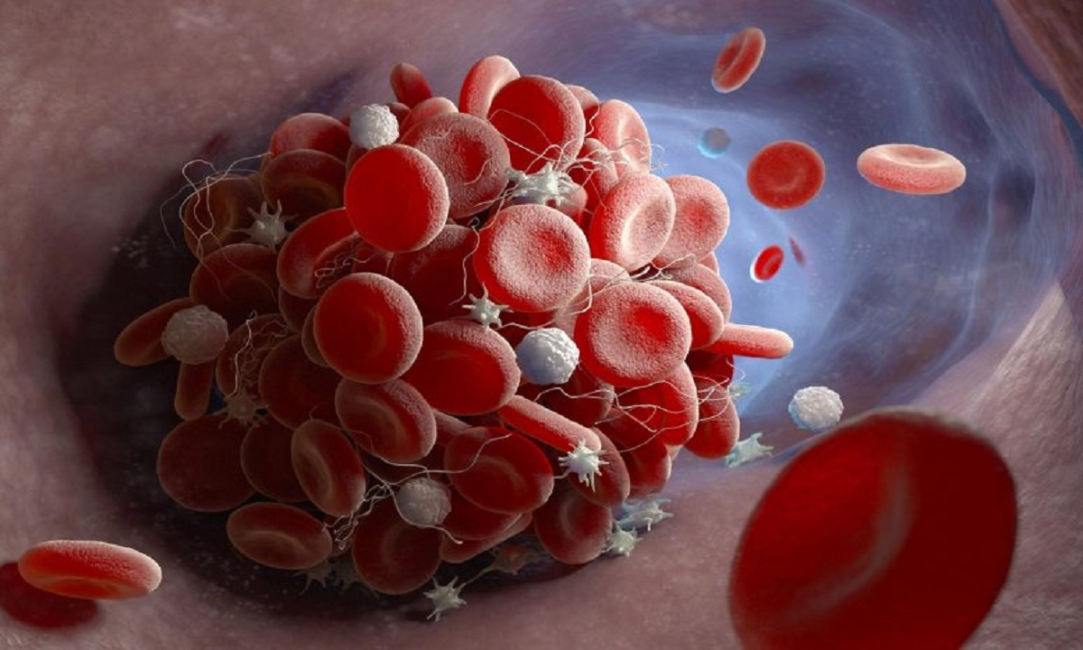 Các nhà khoa học phát hiện kháng thể gây đông máu do COVID-19