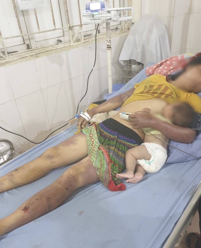 Chồng dùng củi đánh vợ nhập viện ở Sơn La