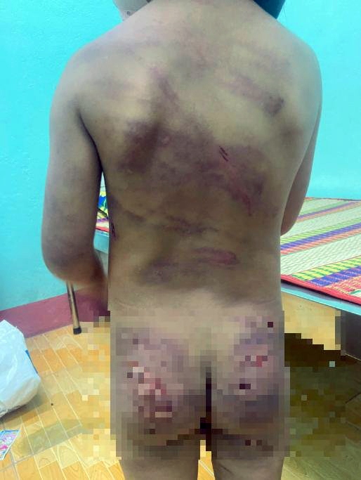 Bé 7 tuổi nghi bị bạo hành ở Bình Phước đã được đưa đi điều trị 